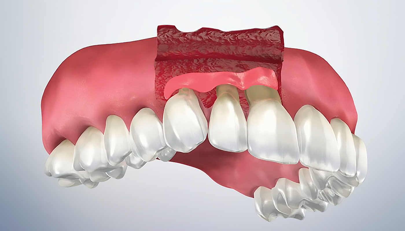 implantologia dentale